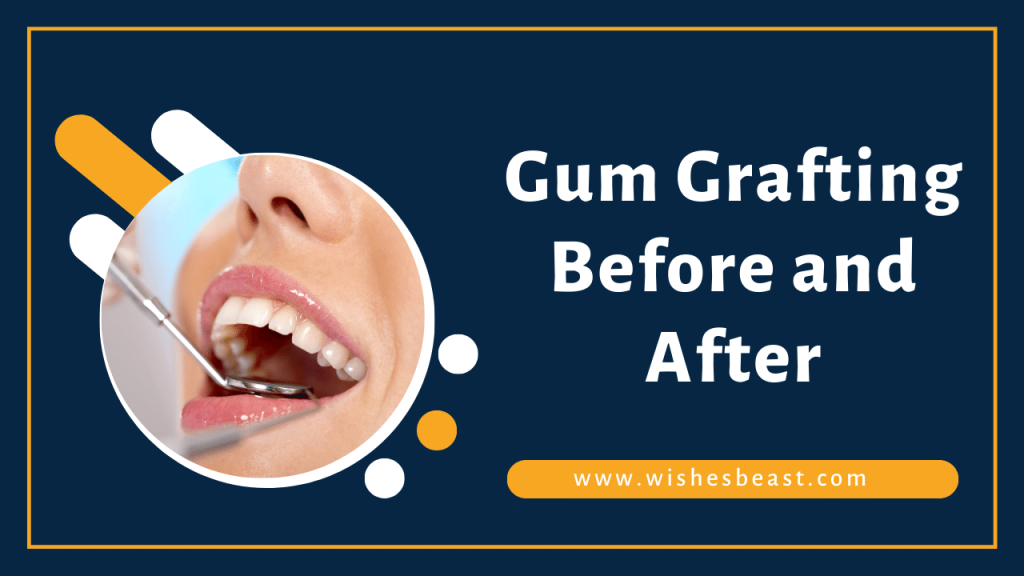 Gum Grafting Before and After