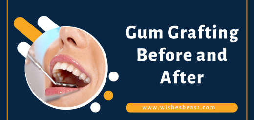 Gum Grafting Before and After
