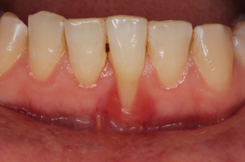 Why Opt for Gum Grafting?